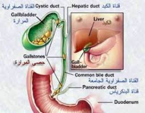  Gallstones